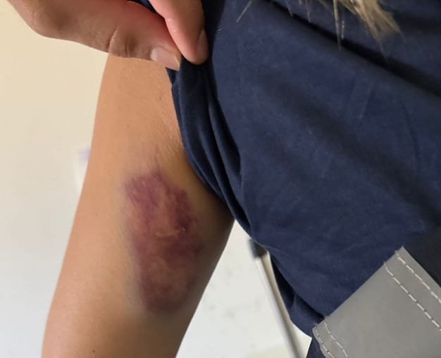 Técnica de enfermagem do SAMU é atropelada a caminho do trabalho em Goioerê; motorista não prestou socorro